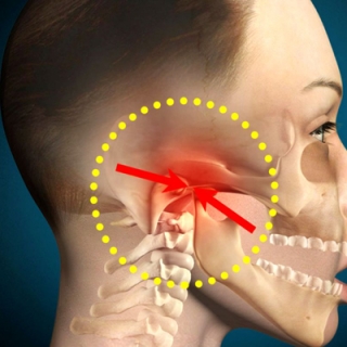 Disfunção temporomandibular Tratamento dor crônica Sorocaba Tratamento Tendinopatia Votorantim
